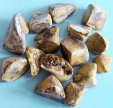 Cholelithiasis and stones