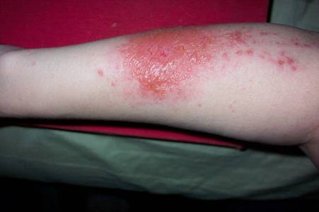 Urushiol induced contact dermatitis 7 days after contact